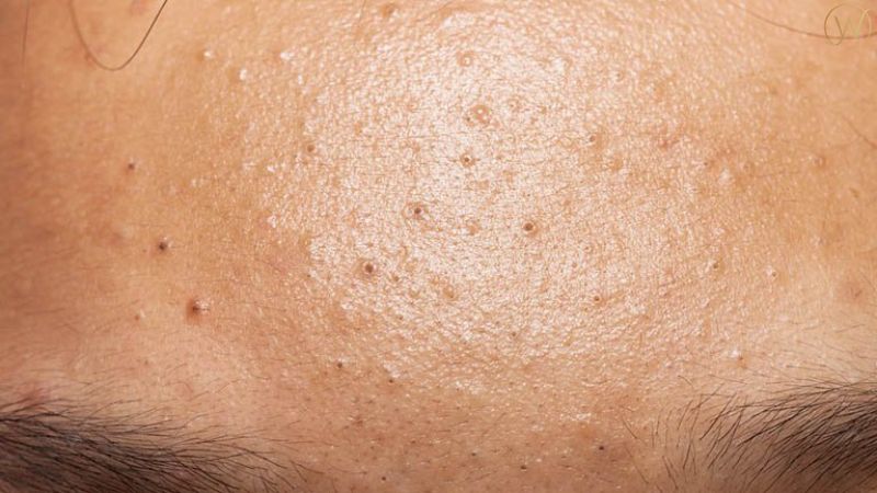 Benzoyl Peroxide 用於治療黑頭粉刺和白頭粉刺。