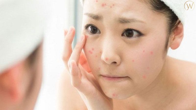 使用 Benzoyl Peroxide 有效治療痘痘的方法