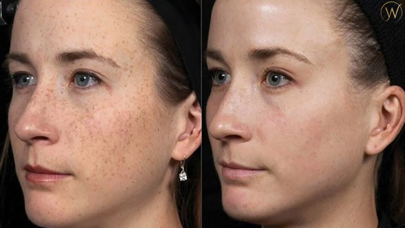 Hydroquinone 在護膚品中的功效