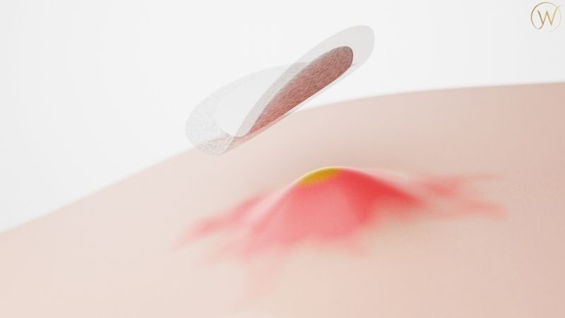 閉鎖性粉刺會如何發展?