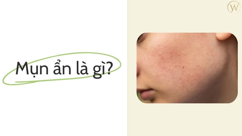 Mụn ẩn là gì?