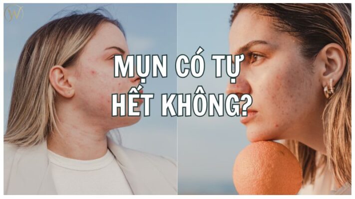 Mụn có tự hết không
