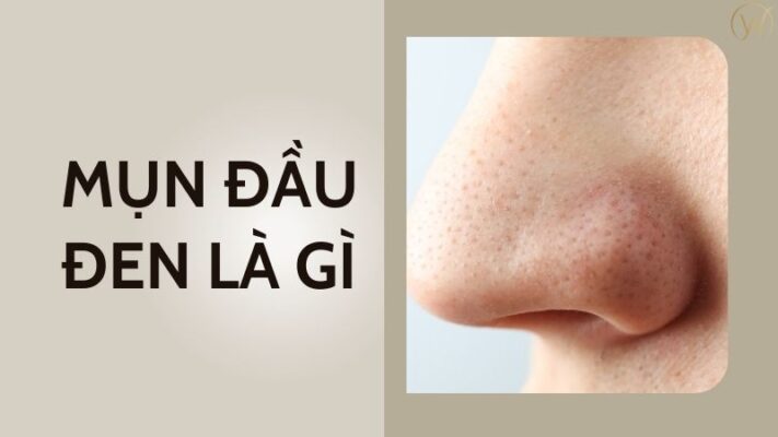 Mụn đầu đen là gì? 