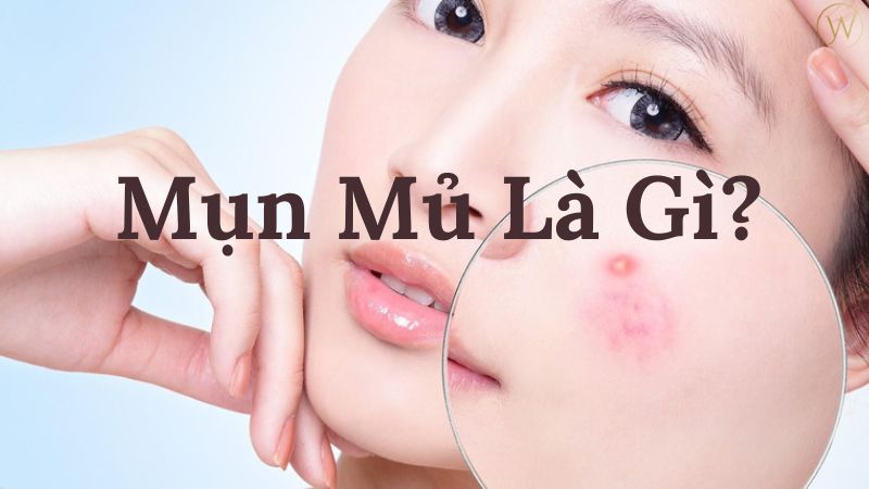 Mụn mủ là gì?