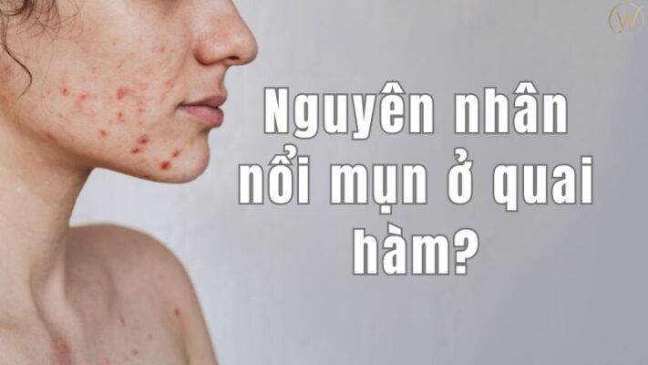 Mụn ở quai hàm