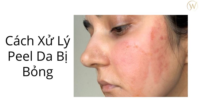 Peel da bị bỏng