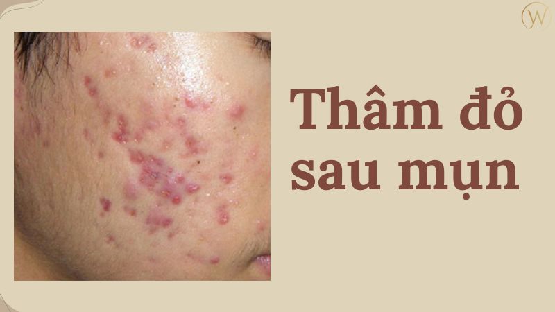 Thâm đỏ sau mụn