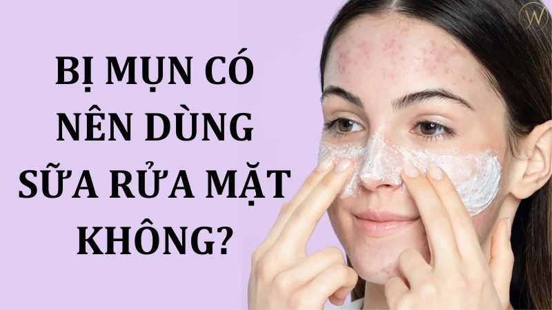 Bị mụn có nên dùng sữa rửa mặt không?